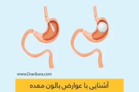 عوارض بالون معده