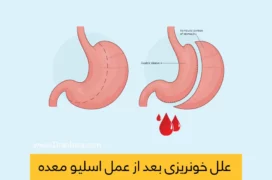 شاخص خونریزی معده بعد از عمل اسلیو معده