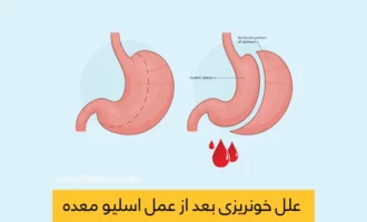 شاخص خونریزی معده بعد از عمل اسلیو معده