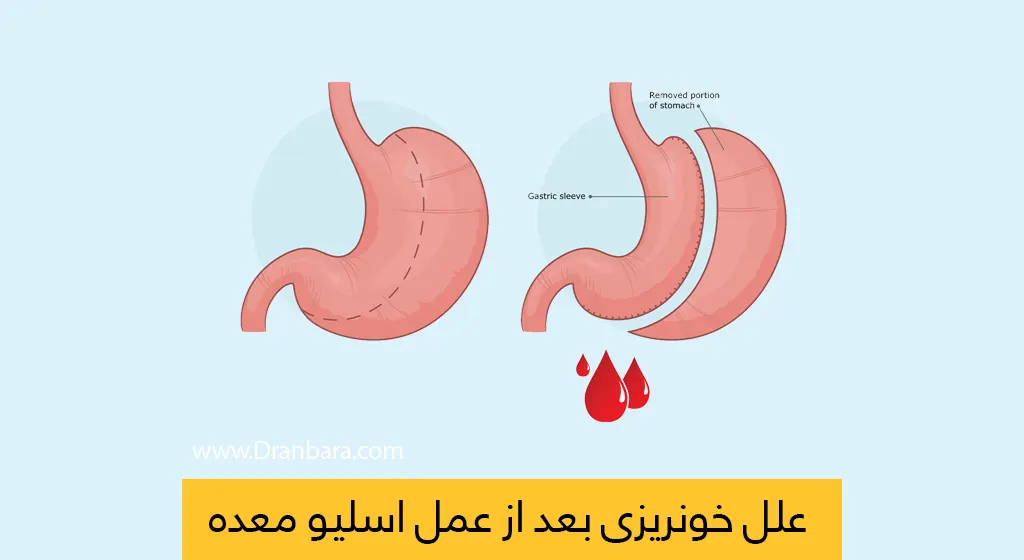 شاخص خونریزی معده بعد از عمل اسلیو معده