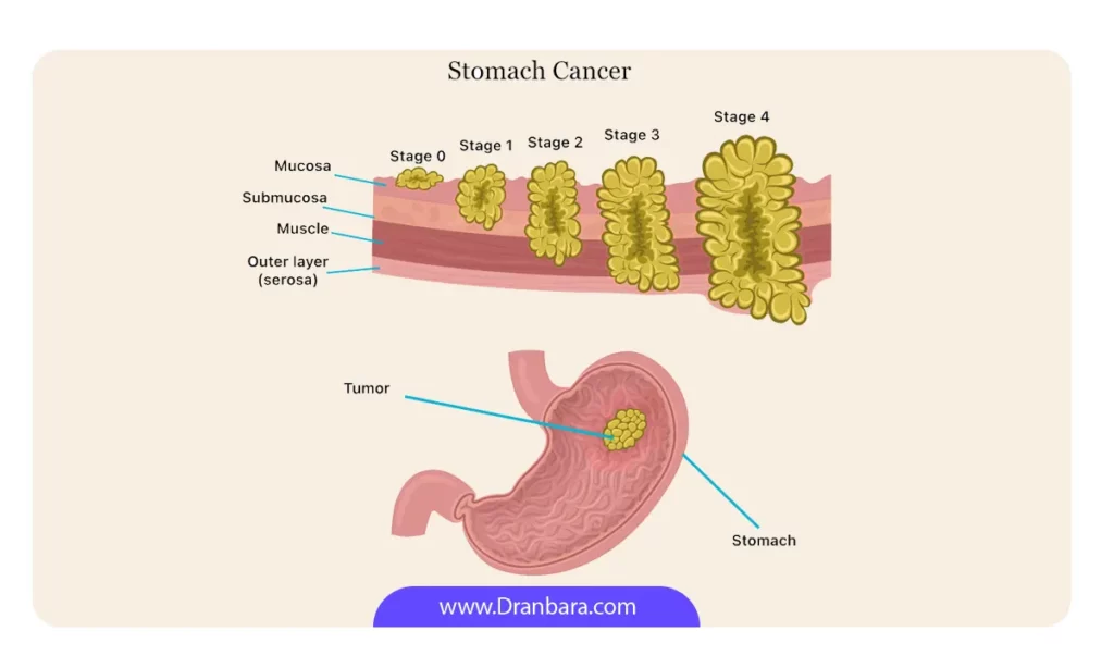 مراحل سرطان معده اینفوگرافی