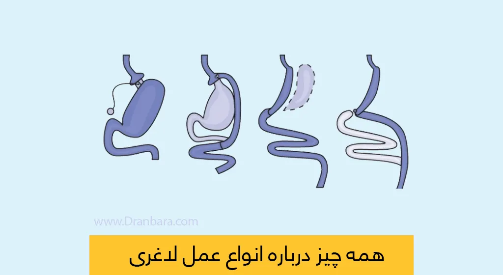 عکس انواع عمل لاغری