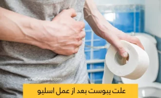 یبوست بعد از عمل اسلیو معده