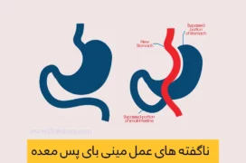 عمل مینی بای پس معده