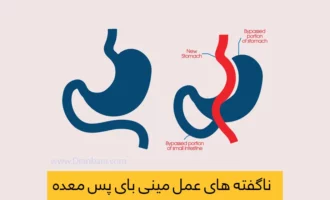 عمل مینی بای پس معده