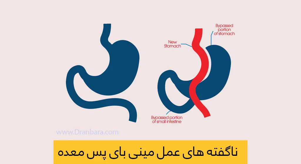 عمل مینی بای پس معده