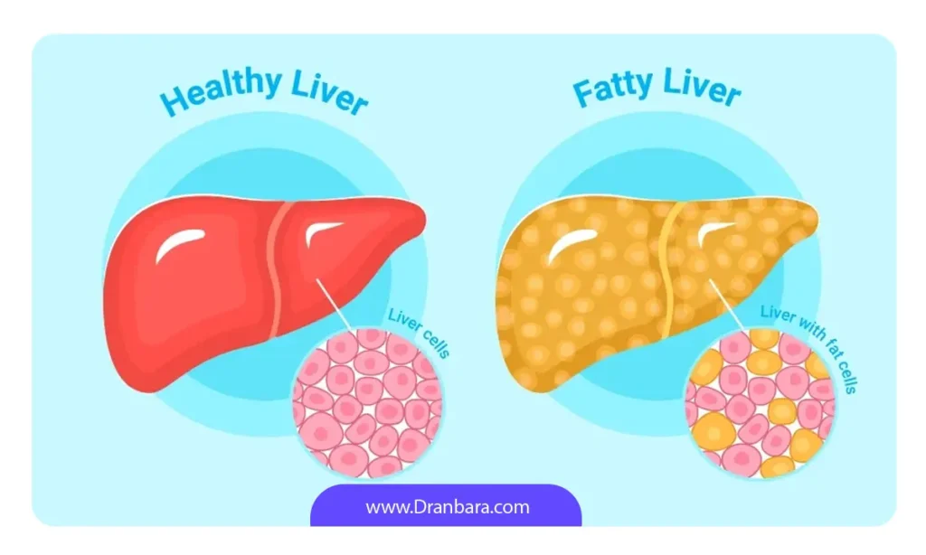 چربی های کبد