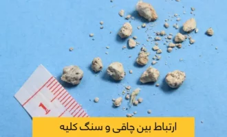 ارتباط بین چاقی و سنگ کلیه شاخص