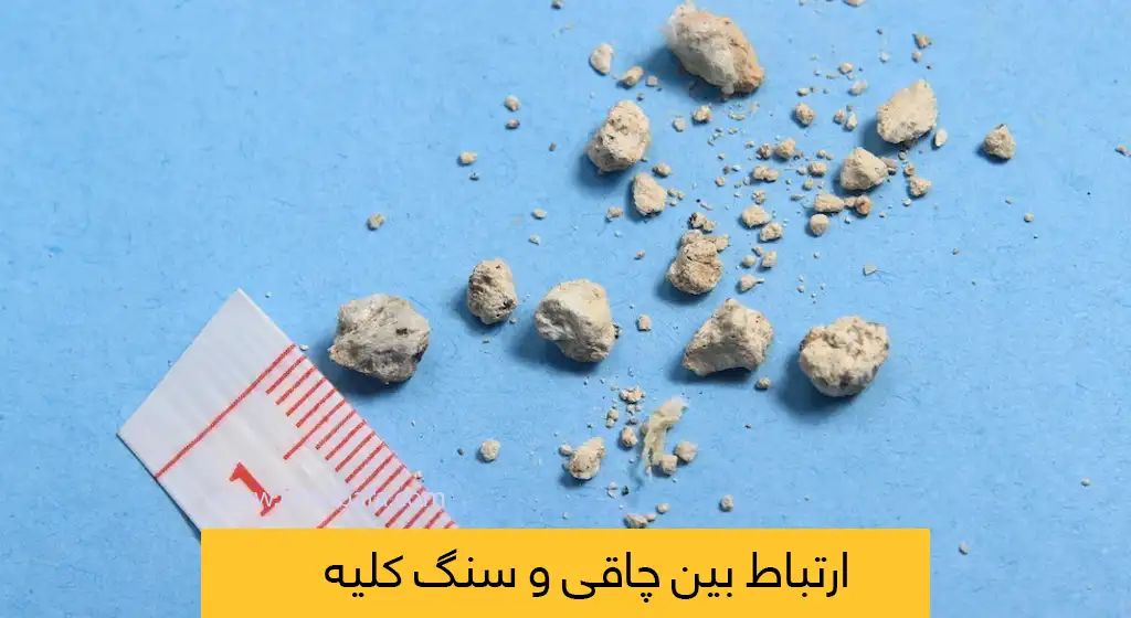 ارتباط بین چاقی و سنگ کلیه شاخص