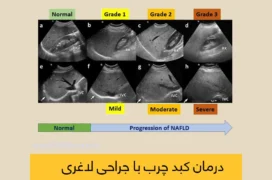 درمان کبد چرب با جراحی لاغری شاخص