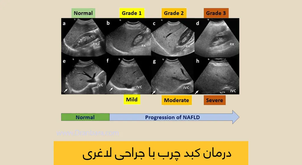درمان کبد چرب با جراحی لاغری شاخص