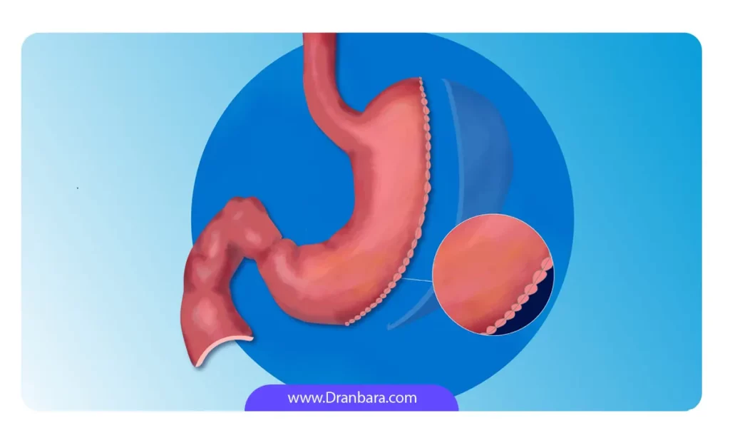 عمل جراحی اسیلو معده