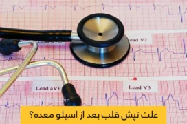 تپش قلب بعد از عمل اسیلو معده