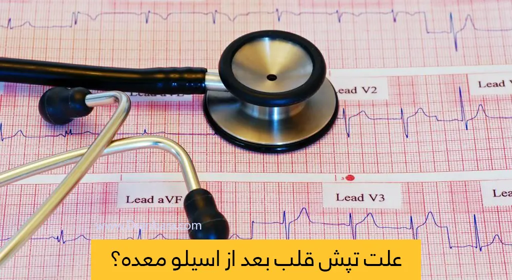 تپش قلب بعد از عمل اسیلو معده