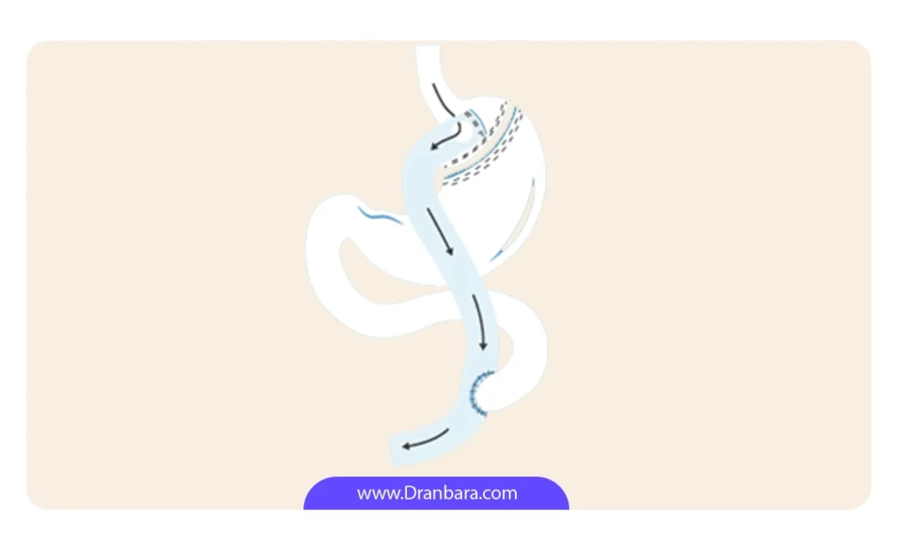 تصویر شماتیک عمل بای پس معده