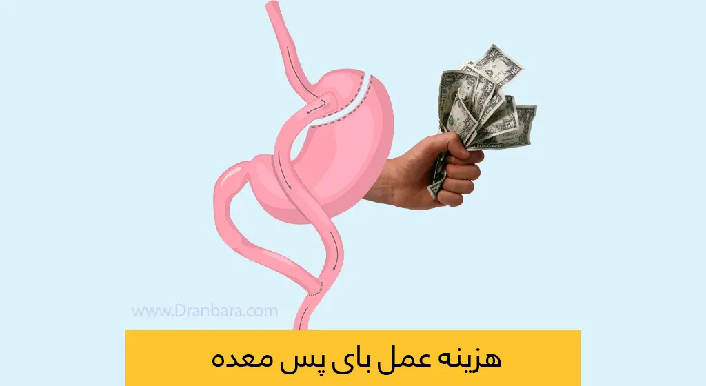 هزینه بای پس معده شاخص