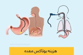 هزیه بوتاکس معده