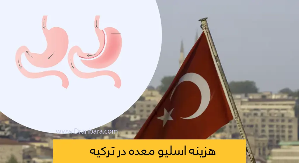 هزینه اسلیو معده در ترکیه
