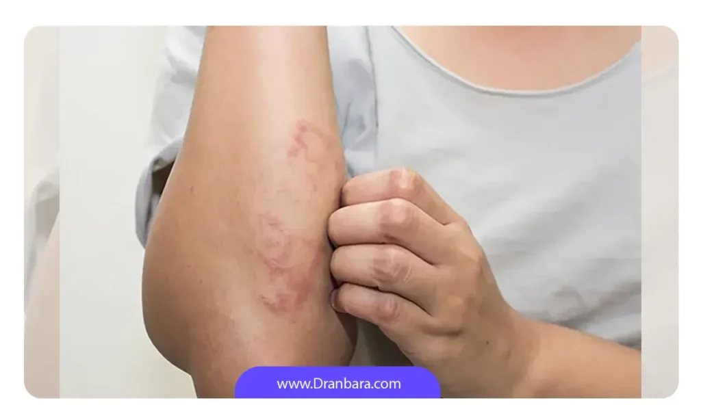 عوارض  آمپول ترولیسیتی