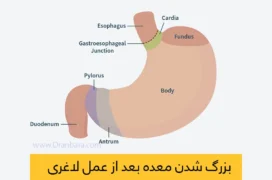 گشاد شدن معده بعد از عمل اسلیو