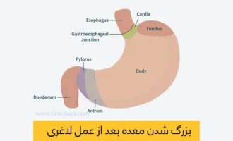 گشاد شدن معده بعد از عمل اسلیو