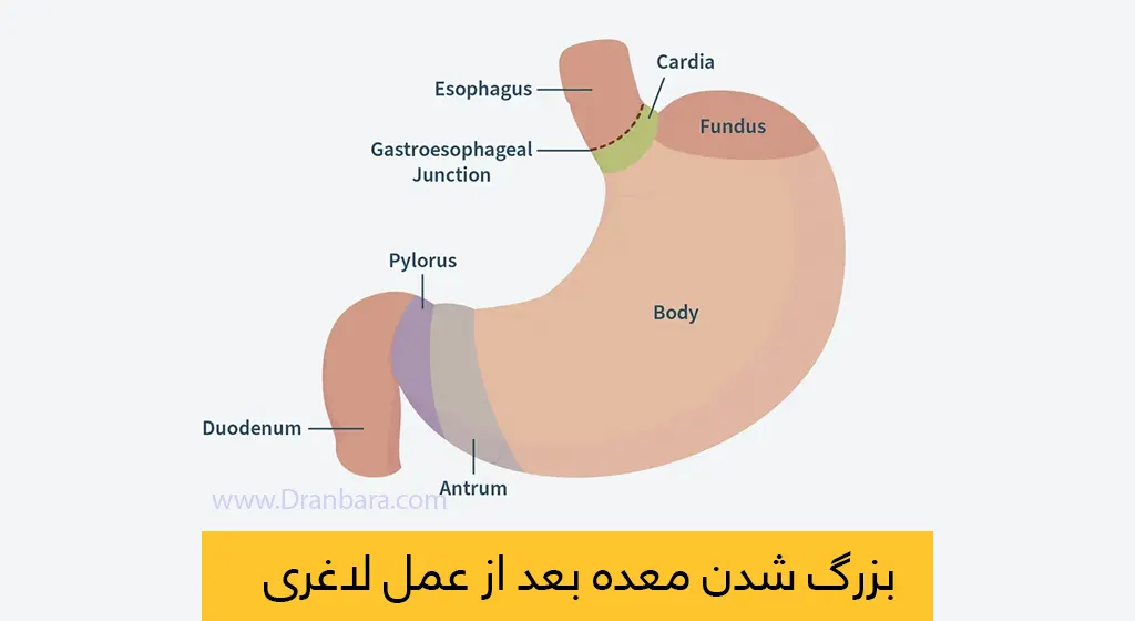 گشاد شدن معده بعد از عمل اسلیو